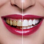 Отбеливание зубов. Что нужно знать про эту процедуру?