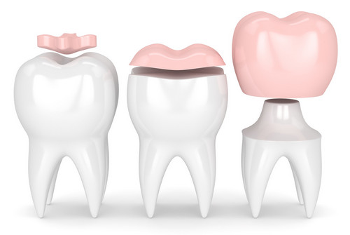 Реставрация зубов. Какой метод выбрать?