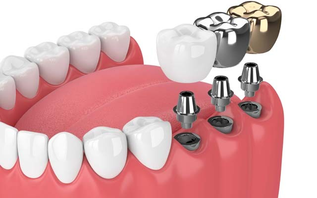Скидка 10% на установку зубных имплантов до конца марта!